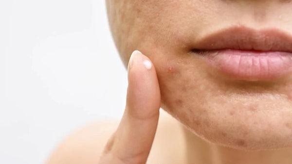 Um guia completo para o tratamento da acne: O seu caminho para uma pele limpa